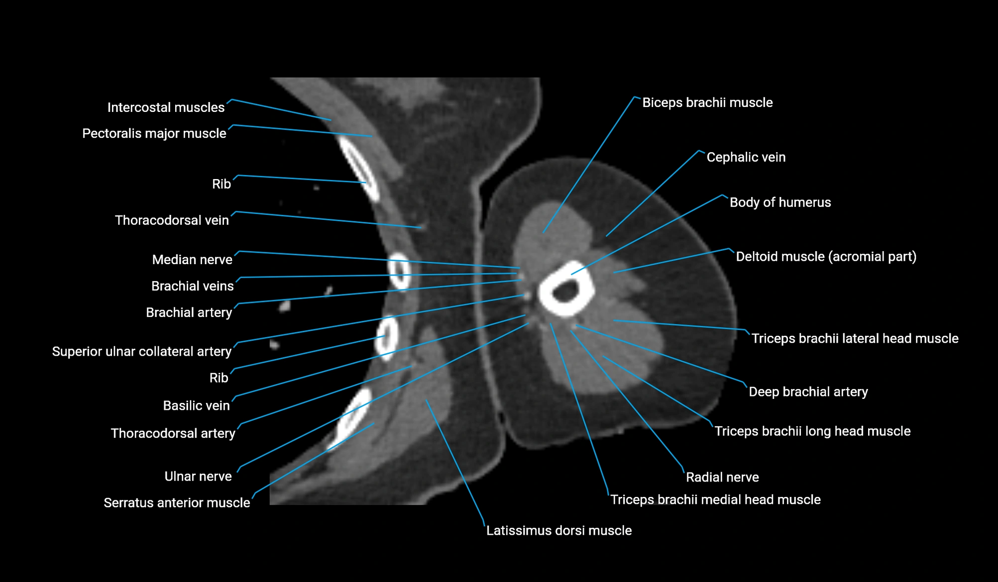 CT upper arm axial  cross sectional anatomy labelled radiology image -00208.webp